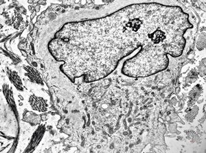 F, 49y. | myelosarcoma … histiocyte-like cells in dermal infiltrates